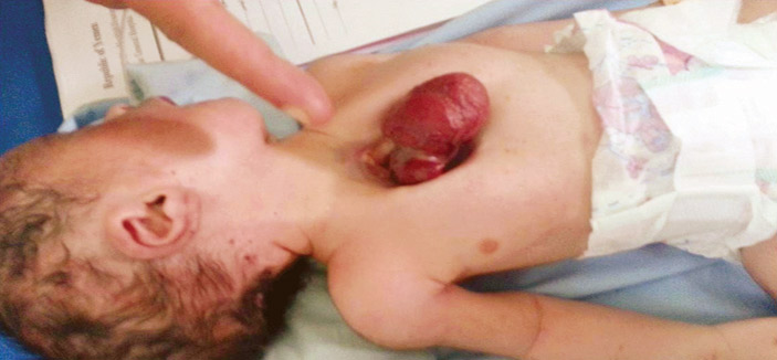 في حالة نادرة .. ولادة طفل يمني قلبه خارج القفص الصدري 
