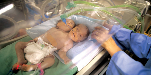 مستشفى الشفاء بغزة يشهد حالة ولادة لطفل برأسين 