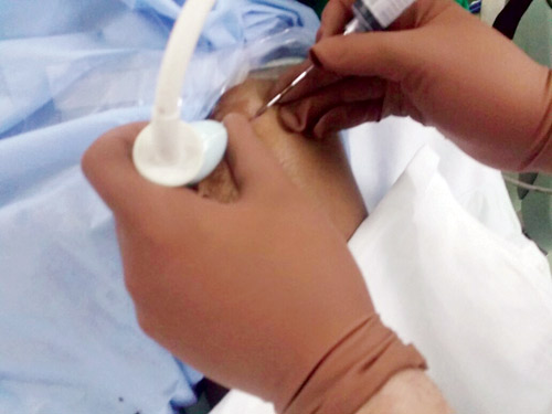 فريق طبي بمستشفى عفيف ينهي معاناة مقيم من «الغرغرينا» 