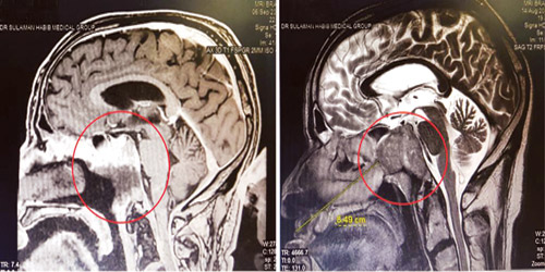 إنهاء معاناة سبعيني باستئصال ورم في قاع المخ في مستشفى د. سليمان الحبيب بالقصيم 