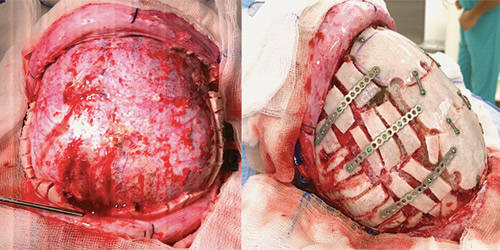  صورة توضح شكل الجمجمة قبل وبعد الجراحة