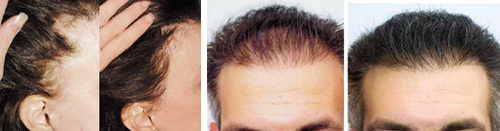 حقائق حول عمليات زراعة الشعر