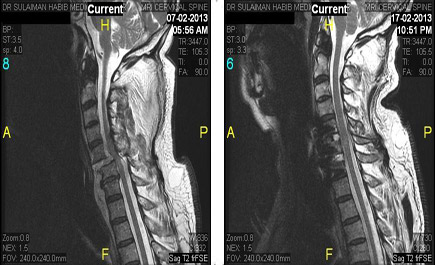 إنقاذ حياة رجلين أصيبا في النخاع الشوكي جراء حادث مروع 