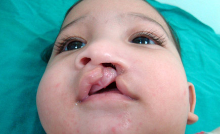 إصلاح الشفة الأرنبية لطفل بتخصصي الطائف 