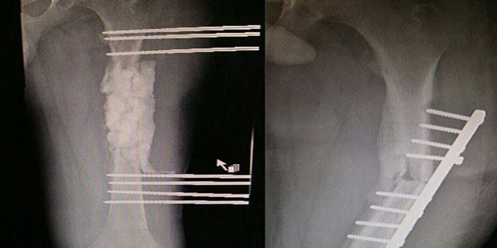  صورة للأشعة قبل وبعد العملية