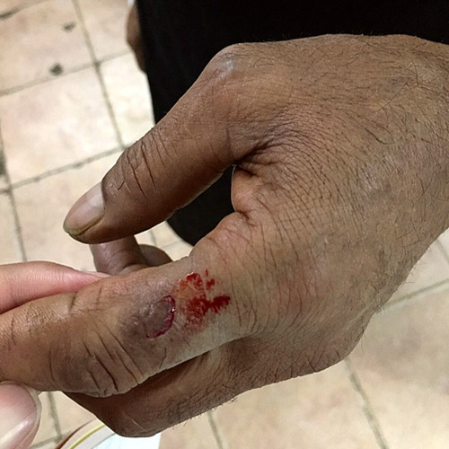  عامل في أحد المطاعم وتظهر الجروح على يده