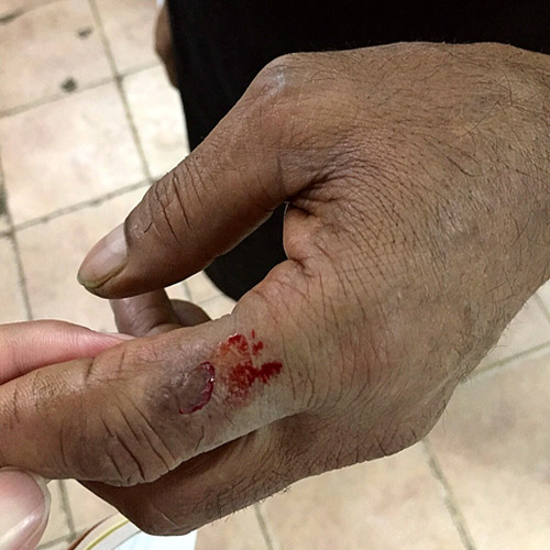  عامل في أحد المطاعم وتظهر الجروح على يده