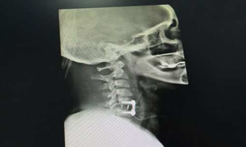 تعاني من كسر وخلع بالفقرات العنقية 