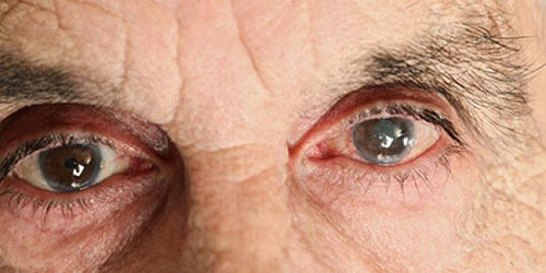 الحفاظ على سلامة البصر يدعم الصحة العقلية في سن متقدمة 