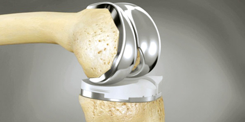  المفصل الاصطناعي