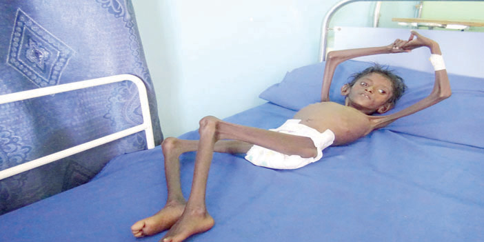  طفل يمني يعاني نقصاً في التغذية جراء منع الحوثيين المساعدات الإنسانية