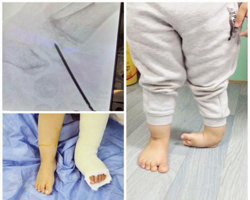  قدم الطفل قبل وبعد العملية الجراحية الناجحة