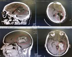 استئصال ورم كبير بالدماغ لـ«خمسيني» في مستشفى د. سليمان الحبيب بالقصيم 