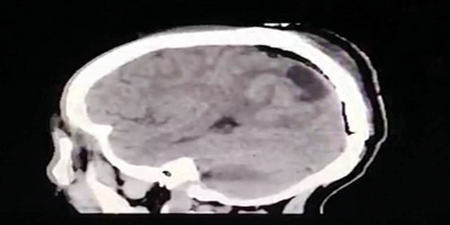 استئصال ورم من دماغ معتمر 