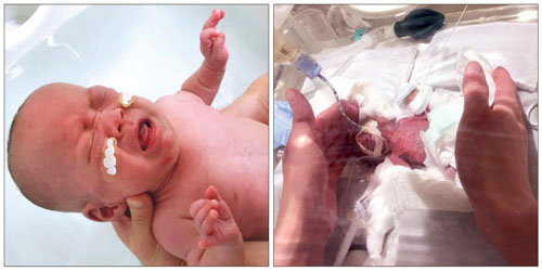 أصغر فتى حديث الولادة في العالم يغادر المستشفى 