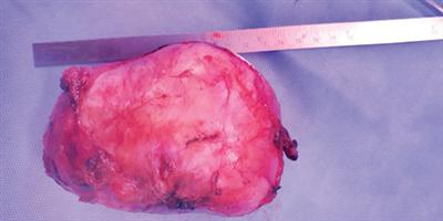 استئصال ورم عصبي نادر بمنطقة الحوض لفتاة  بمدينة الملك عبدالله الطبية بمكة 