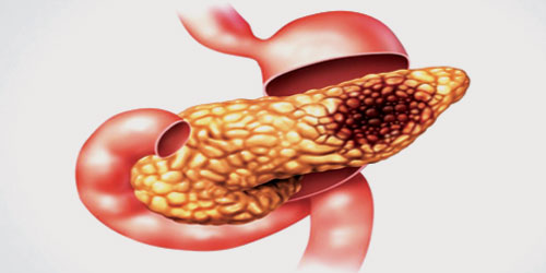 سرطان البنكرياس  مميت للبدناء قبل سن الخمسين 
