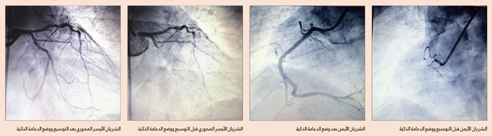 إنقاذ مريض من جلطة حادة مزدوجة بشرايين القلب أدت إلى توقف بعضلة القلب بالمستشفى السعودي الألماني بالرياض 