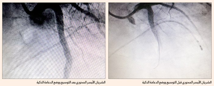 في إنجاز جديد لقسم القلب 