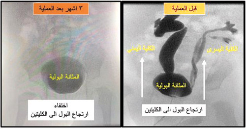 مستشفى «دله النخيل» ينجح في وقف ارتجاع بولي من المثانة إلى الكليتين لحالة نادرة بالمنظار الجراحي تبلغ من العمر 10 أشهر 