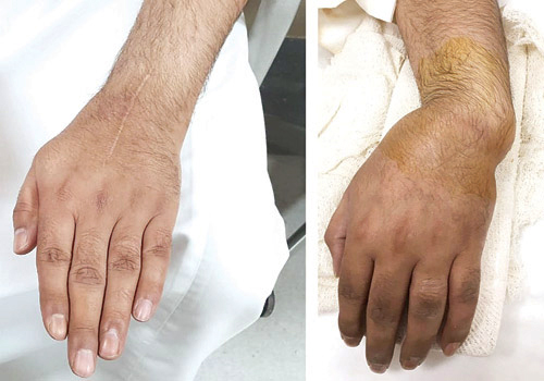 3 عمليات بمستشفى د. سليمان الحبيب بالقصيم تعيد وظائف اليد اليسرى لشاب 