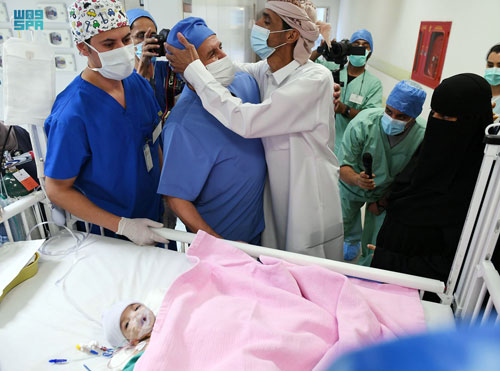 نجاح عملية فصل التوأم الطفيلي اليمني 