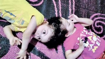 التوأم السيامي المصري «سلمى وسارة» يصل إلى الرياض قريباً للنظر في إمكانية فصلهما 