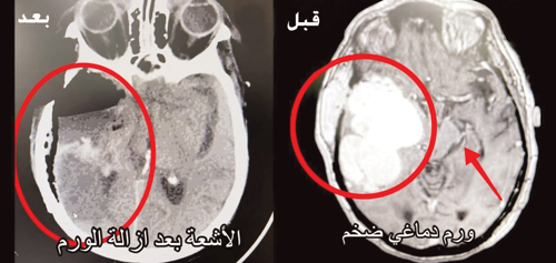 تسبب لها في نوبات من الصرع الحاد والصداع الشديد 