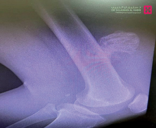 عملية مُعَقّدة بمستشفى سليمان الحبيب تُنهي معاناة شاب من «كتلة» في الفخذ 