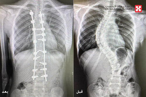 عبر عملية معقدة استمرت 6 ساعات 