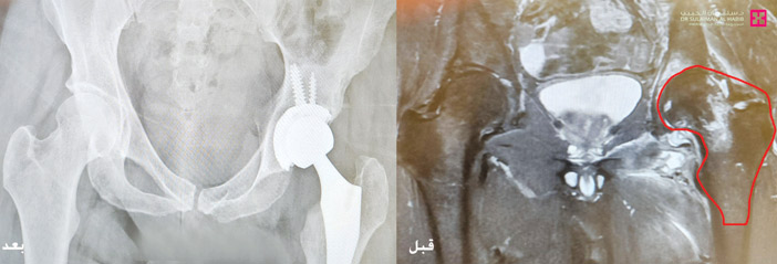 مستشفى الدكتور سليمان الحبيب بالصحافة يُنهي معاناة شاب مع صعوبة المشي والحركة 