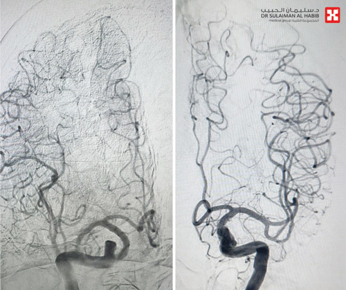 في الشريان الفقري بالمخيخ وبدون جراحة 
