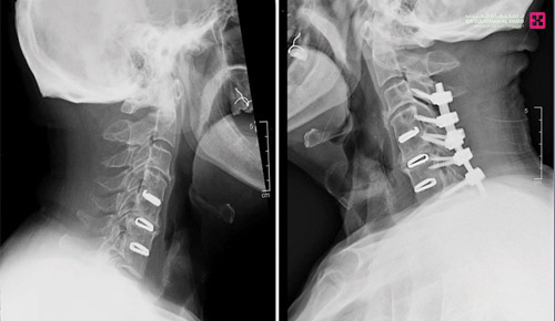 أقعده ضغط بالحبل الشوكي 