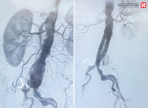 عانى من تضخم حاد وتصلبات 