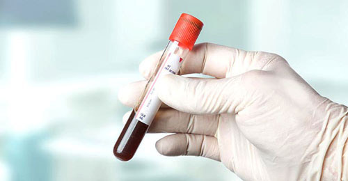 فحص للدم يكشف سرطان القولون بدقة 95 % في مراحله المبكرة 