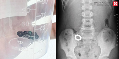 مستشفى الدكتور سليمان الحبيب بالصحافة ينقذ حياة طفل ابتلع «10» كرات مغناطيسية 