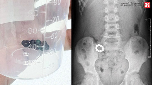 مستشفى الدكتور سليمان الحبيب بالصحافة ينقذ حياة طفل ابتلع «10» كرات مغناطيسية 