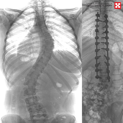 مستشفى الدكتور سليمان الحبيب بالمحمدية في جدة ينهي معاناة فتاة مع «جنف» مزدوج 