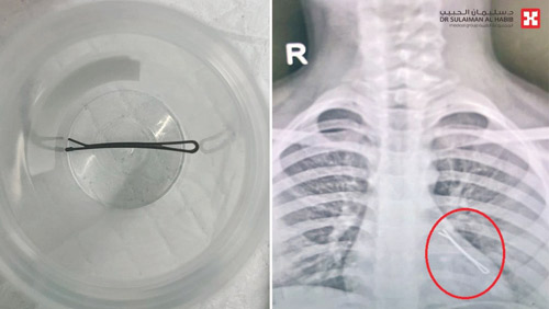 في عملية عاجلة عبر المنظار 