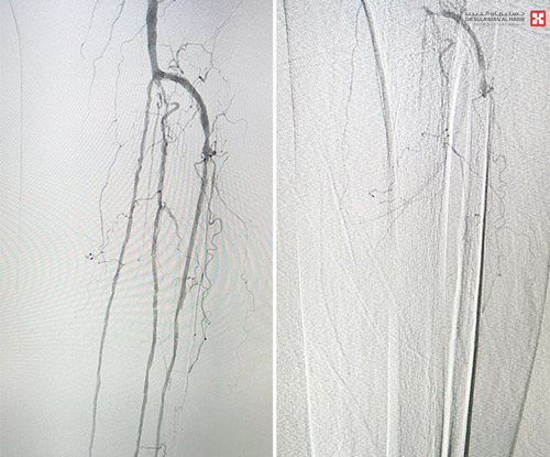 كانت مهددة بالبتر نتيجة غرغرينا متقدمة 