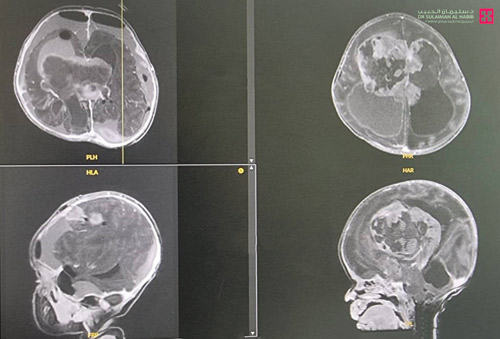 لدى طفلة عمرها 15 يوماً 
