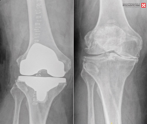 بعملية نوعية لاستبدال مفصل الركبة 