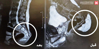 مستشفى الدكتور سليمان الحبيب بالقصيم يستأصل ورماً بالظهر 