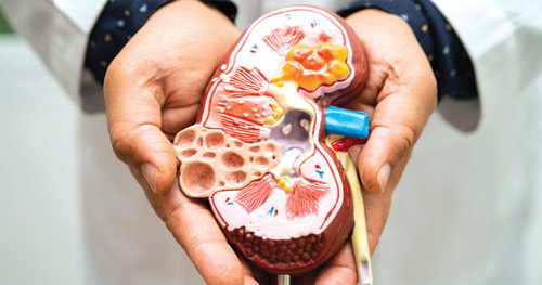 ابتكار علاج جذري لحصوات الكلى 