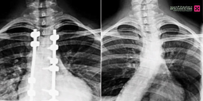مستشفى الدكتور سليمان الحبيب بالصحافة يصحح مَيَلانَاً حاداً بالعمود الفقري 