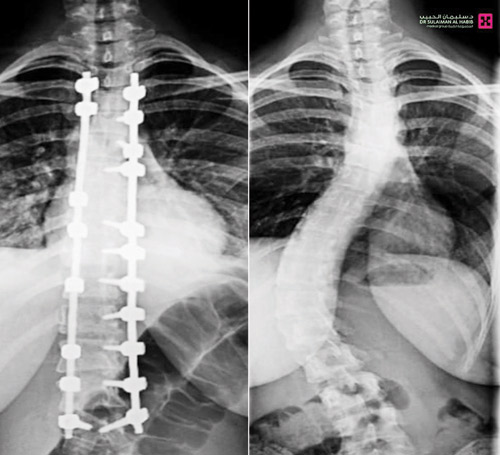 أعاد لفتاة عشرينية حياتها الطبيعية 