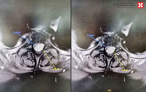 بجراحة مجهرية دقيقة 