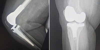 مستشفى الدكتور سليمان الحبيب بالسويدي يستبدل عظمة الفخذ بعملية متقدمة 
