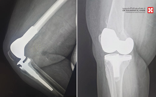 أعادت القدرة على الحركة لمسنّة 