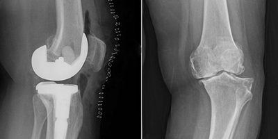 مستشفى الدكتور سليمان الحبيب بالقصيم ينهي معاناة «ستينية» مع آلام الركبة 